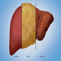 Ispis plakata o zdravoj, masnoj i cirotičnoj jetri Monice Schroeder znanstveni izvor